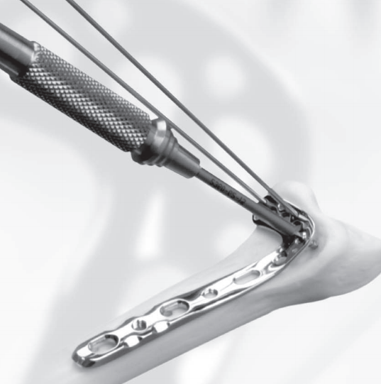 PLP — distal radius fracture
