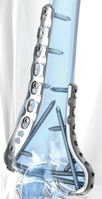 PLP — distal humerus fracture
